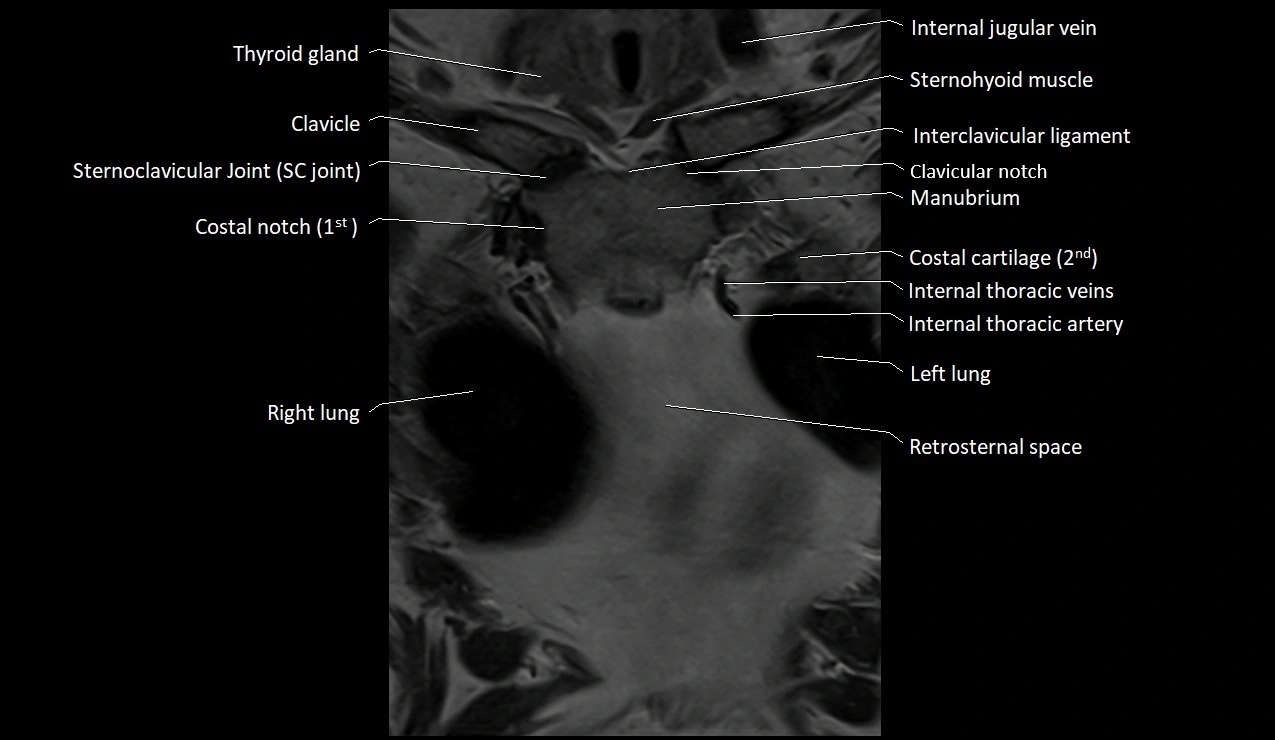 MRI sternum and sternoclavicular joint labeled coronal anatomy image 12.webp
